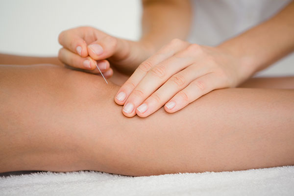 acupuncture