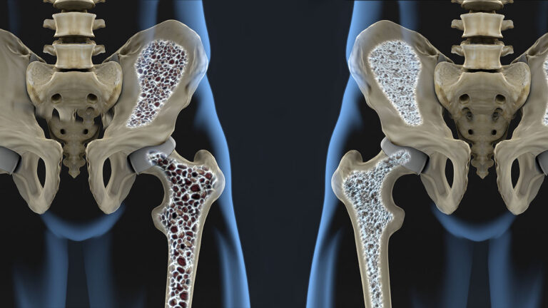 Bone Density