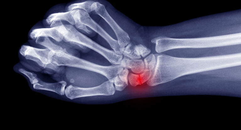 scaphoid iStock 1195986914 cropped copy