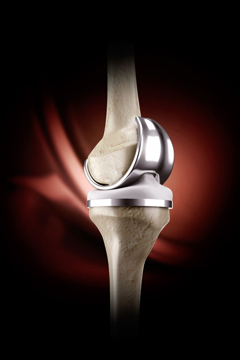 Replacement joint